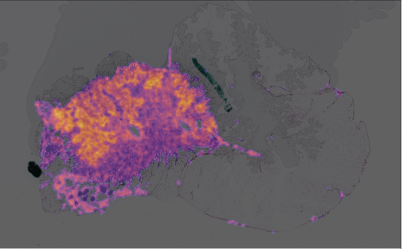 AI-generated cancer heatmap